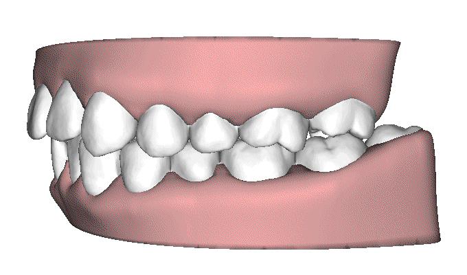 深覆合正畸适合戴隐适美吗,深覆合矫正能戴隐形牙套吗