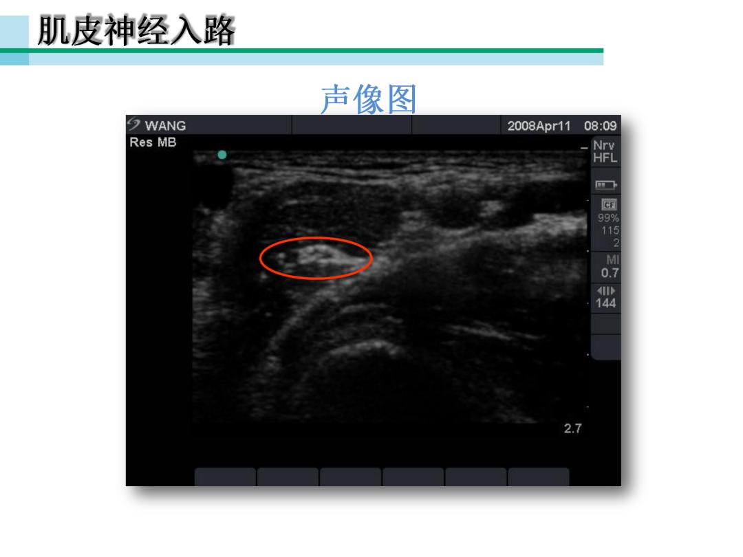 超声引导下臂丛神经阻滞,PPT课件