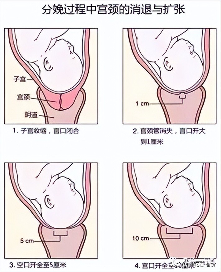 顺产中开十指是什么,顺产开十指指什么