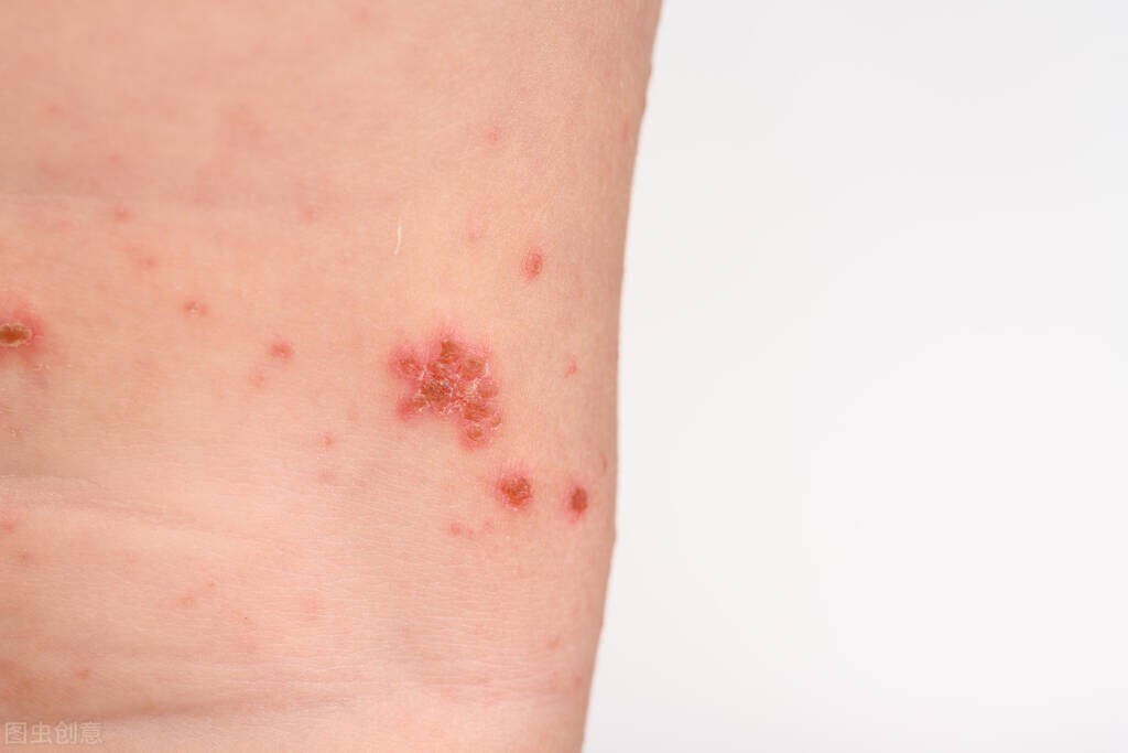 如何避免阴虱传播,阴虱的传播途径有哪些