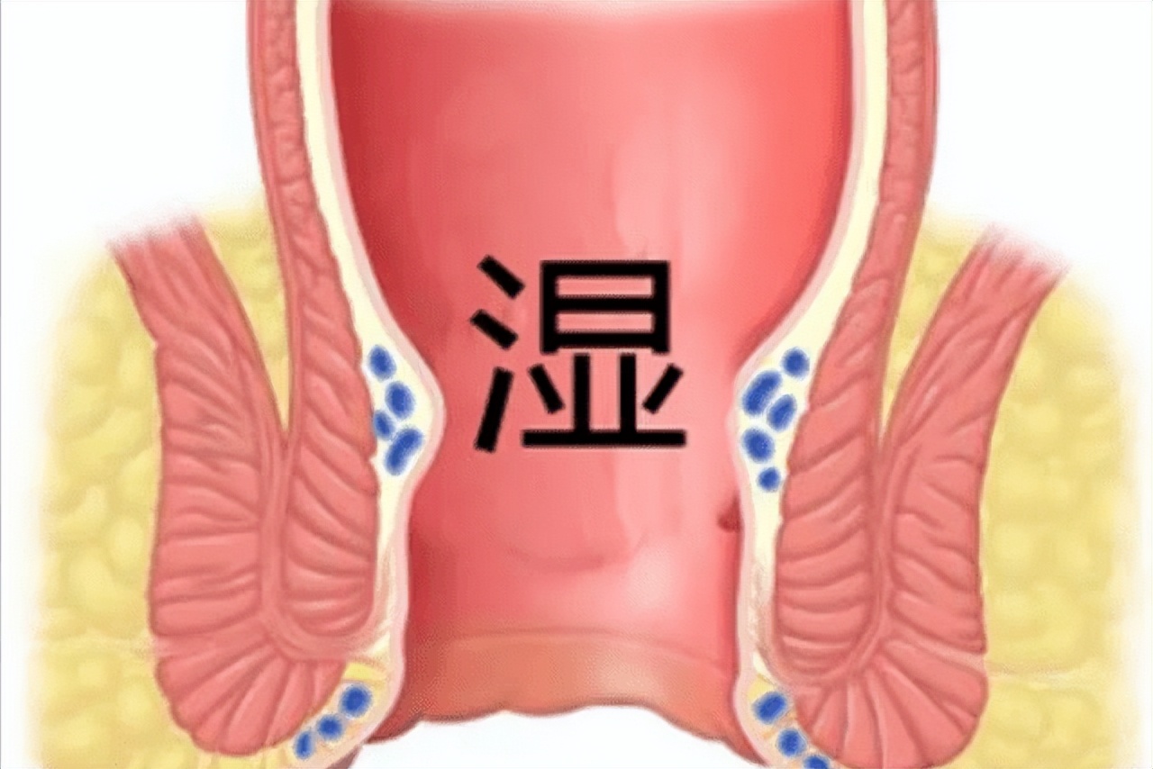你需要了解的有关肛门癌的知识,肛门癌的症状和前兆有治疗方法吗