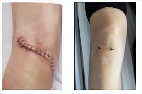 膝关节后面的窝有个包块原因,膝关节后面鼓出一个包是淋巴癌吗