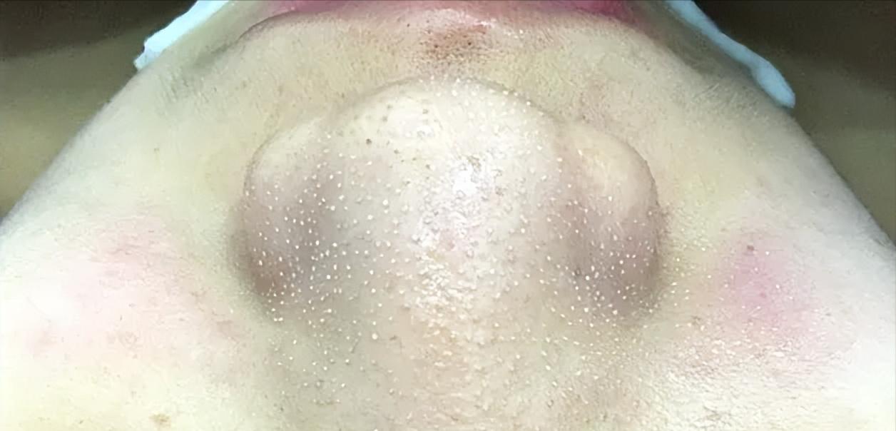 鼻子的黑头跟草莓一样,草莓黑头怎么去除最有效