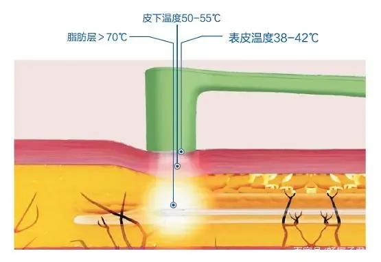 下颌黄金微雕恢复过程,正颌手术改善面中部凹陷