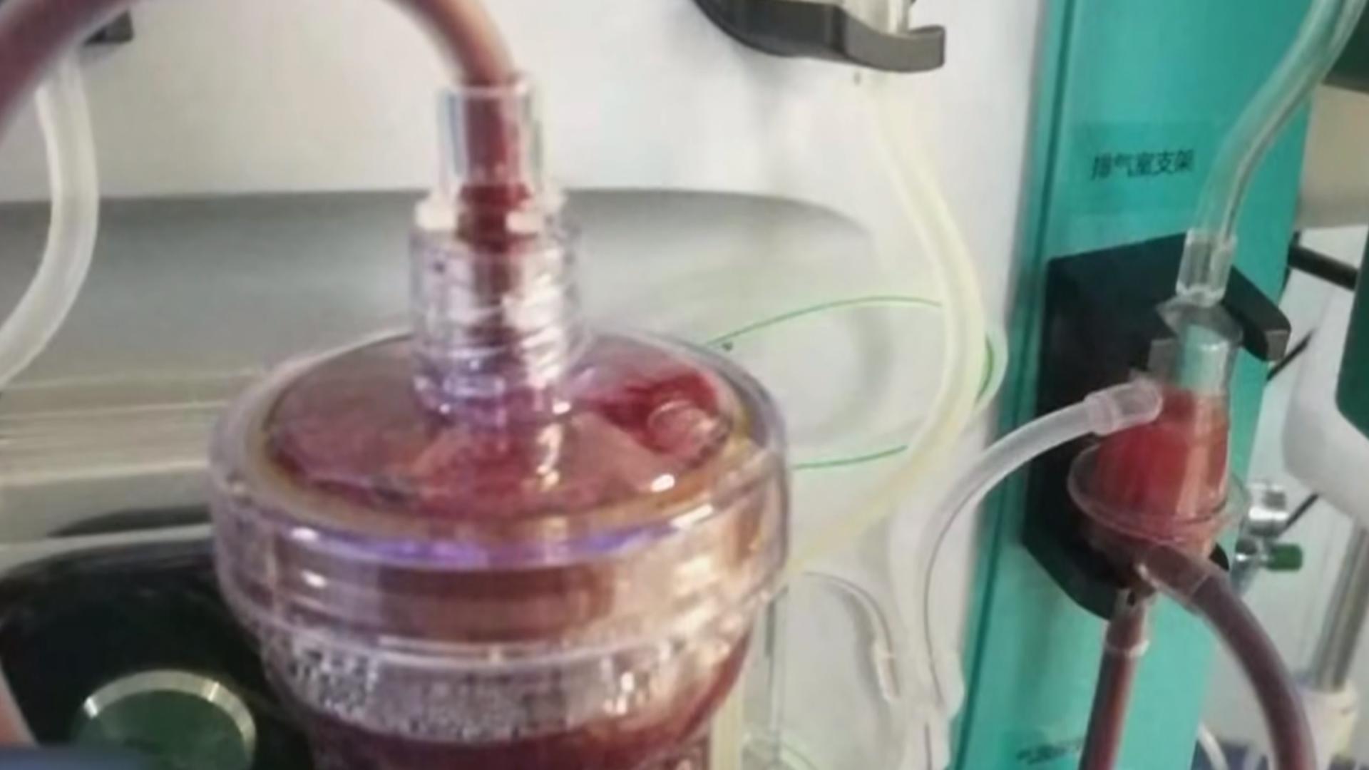 20岁女孩查出糖尿病,杭州17岁少女得了糖尿病