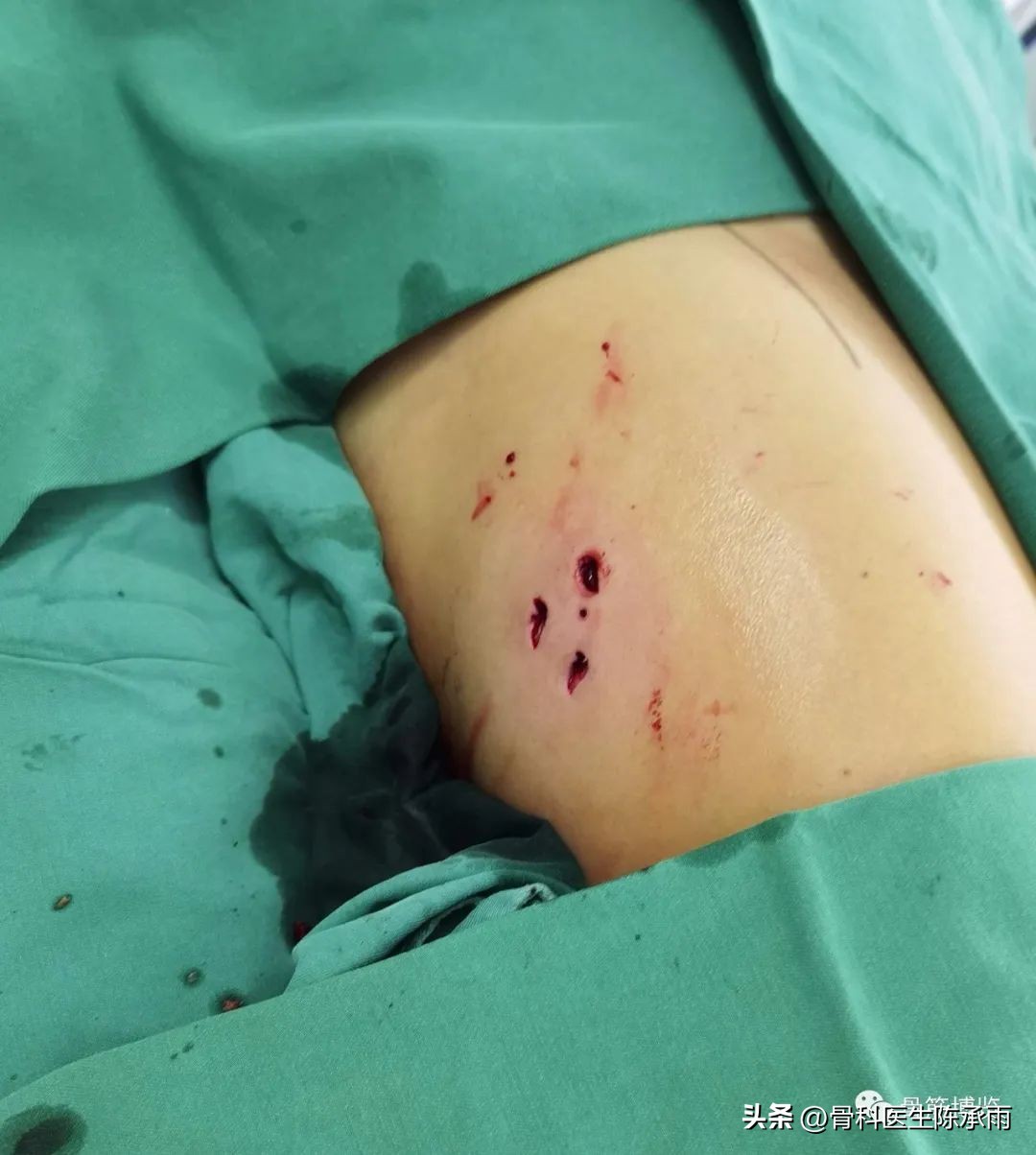 股骨颈闭合复位内固定术后护理,股骨颈骨折闭合复位的技巧