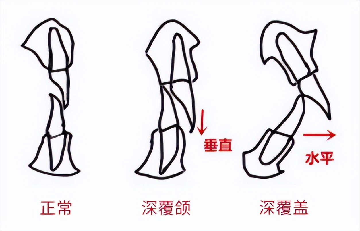 深覆颌深覆盖什么情况下不用矫正,深覆盖和深覆颌哪个严重些
