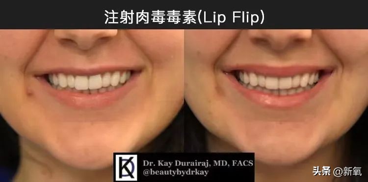 嘴唇薄变丰满,嘴唇变凸变丑怎么办
