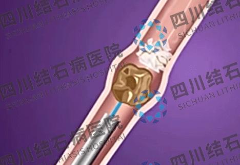 输尿管结石什么情况下需要碎石,输尿管结石的最佳治疗方法有哪些