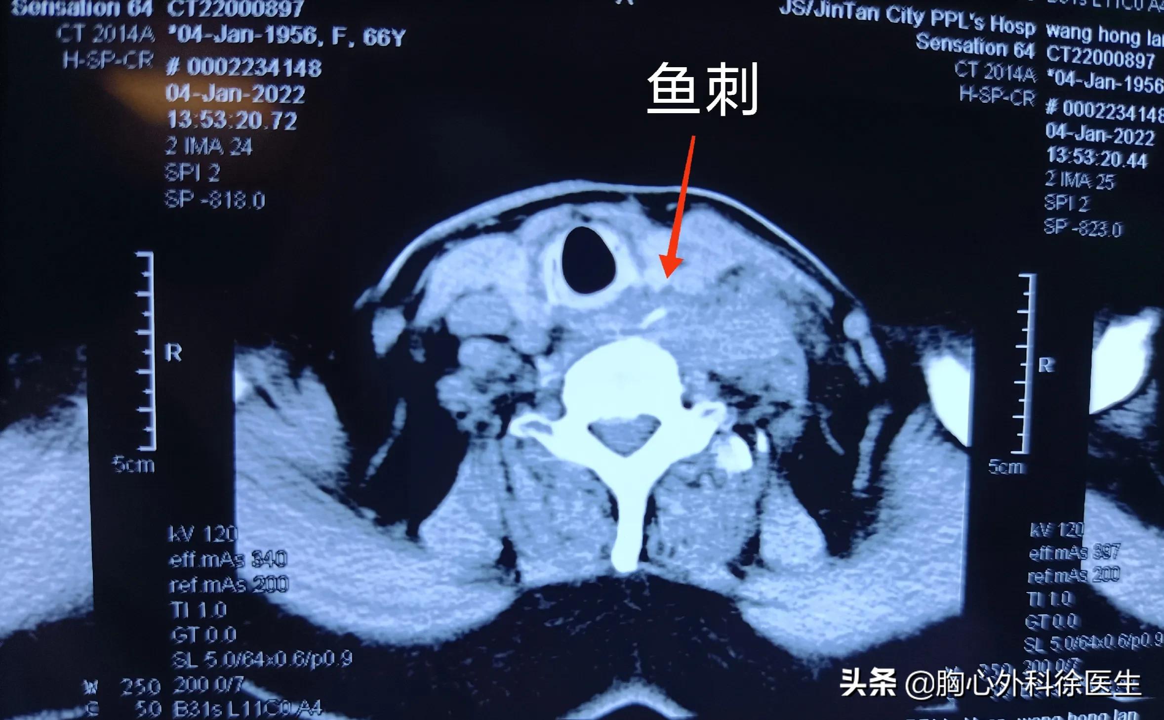 鱼刺卡喉做喉镜需要抽血化验吗,鱼刺卡喉医院是如何治疗