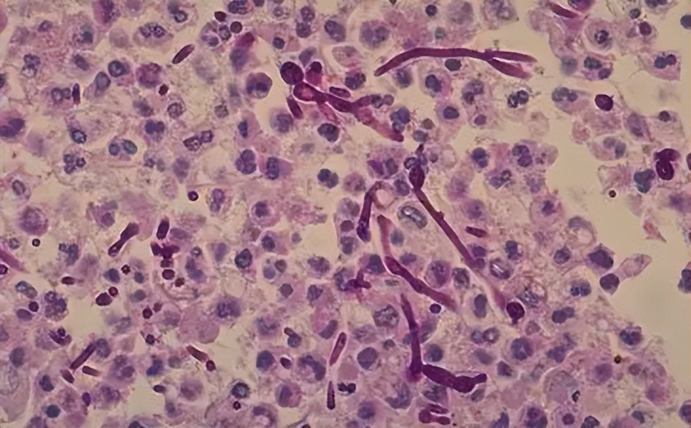 皮肤念珠菌病是什么症状,皮肤念珠菌病传染吗