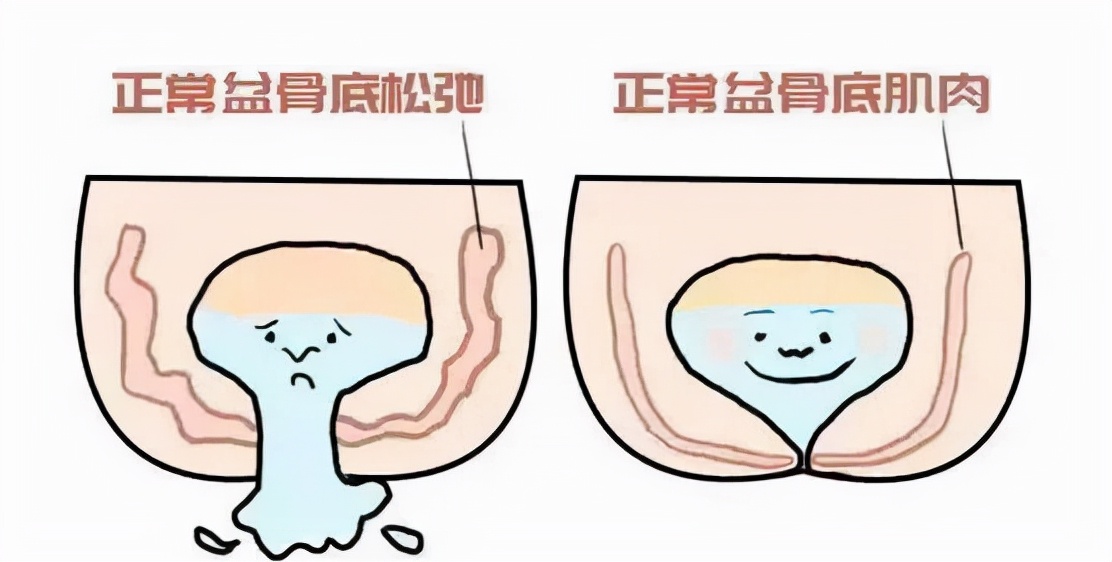 女人绝经后子宫脱垂是怎么回事,女性老了之后子宫会从哪里掉出来