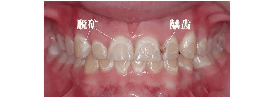 用完牙贴牙齿出现了白斑怎么回事,牙齿出现白斑吃什么食物能治好