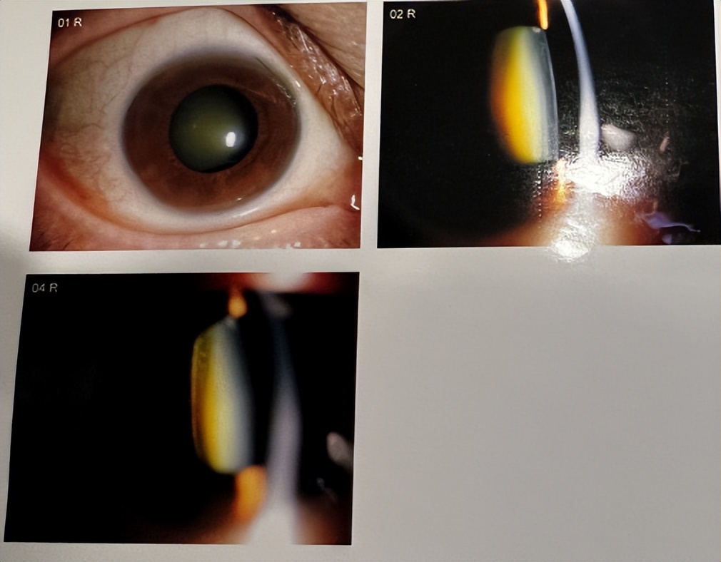 先天性白内障术后矫正视力有三招,白内障摘除术后视力矫正最佳方式