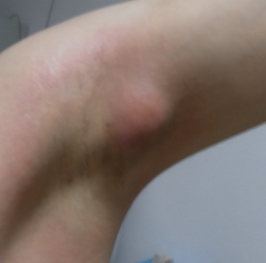 艾滋病腋下肿块,女子洗澡发现腋窝肿块