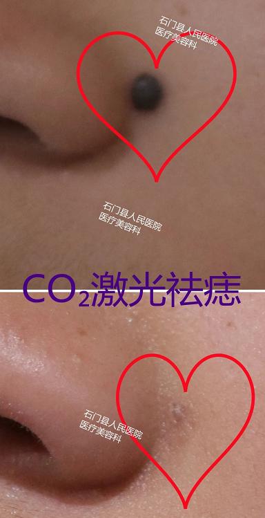 哪些痣应该点哪些痣不应该点,痣多适合什么点痣方法