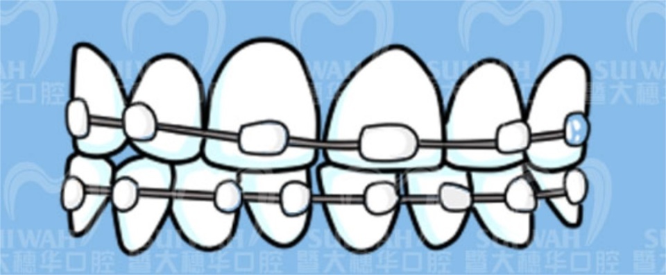 牙齿缝隙越来越大是怎么回事,45岁牙齿缝隙越来越大能矫正吗