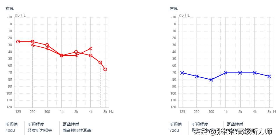 两只耳朵听力不一样正常么,2个耳朵听到的声音不同步