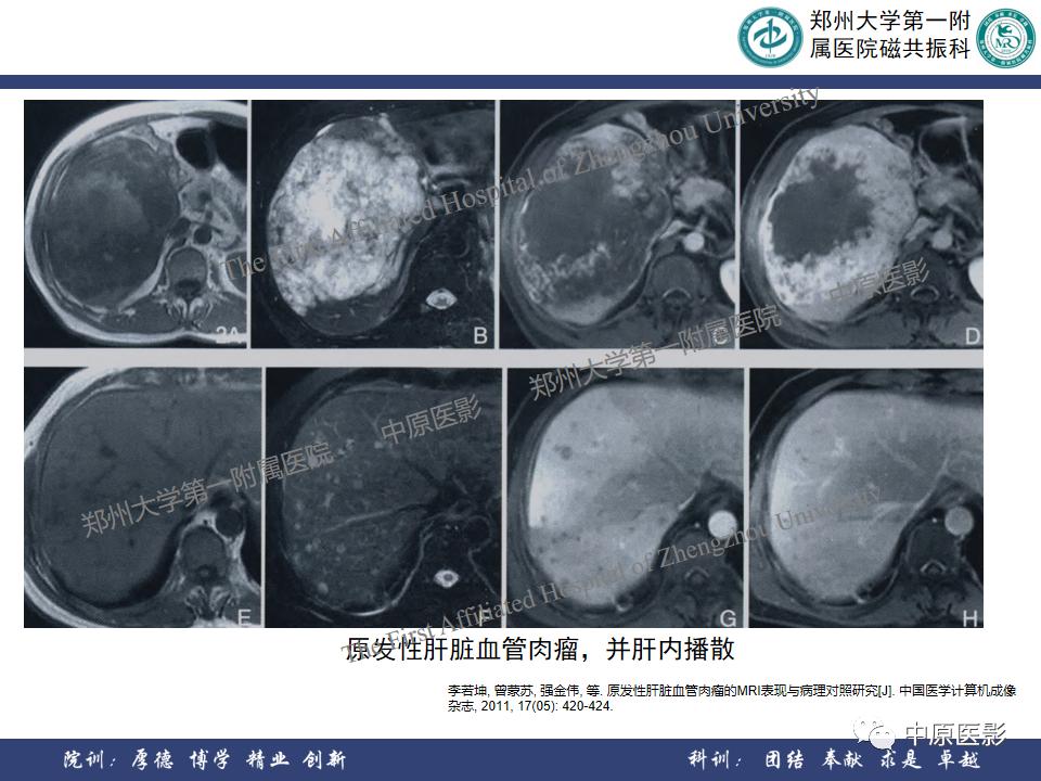 肝脏血管瘤样本,正确认识肝脏血管瘤文章