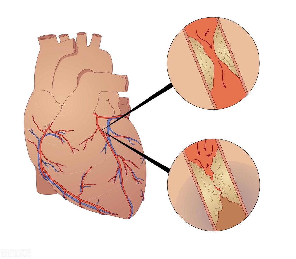 小伙子胸痛去医院挂急诊做ct,女子胸闷胸痛确诊冠心病