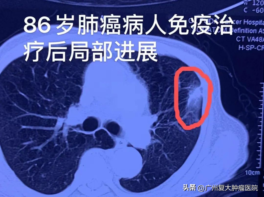 九十岁以上老人肺癌怎么办,九旬老人肺癌晚期咳痰怎么办