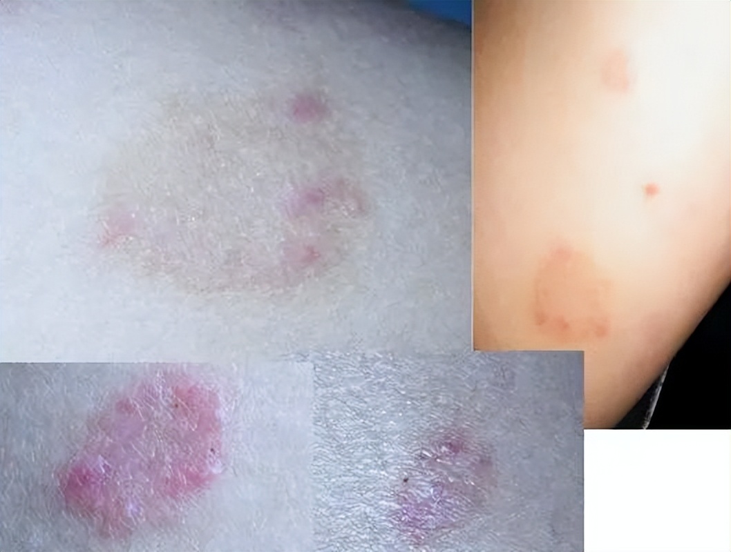 银屑病头皮屑症状中医,银屑病头屑增多是好转还是加重