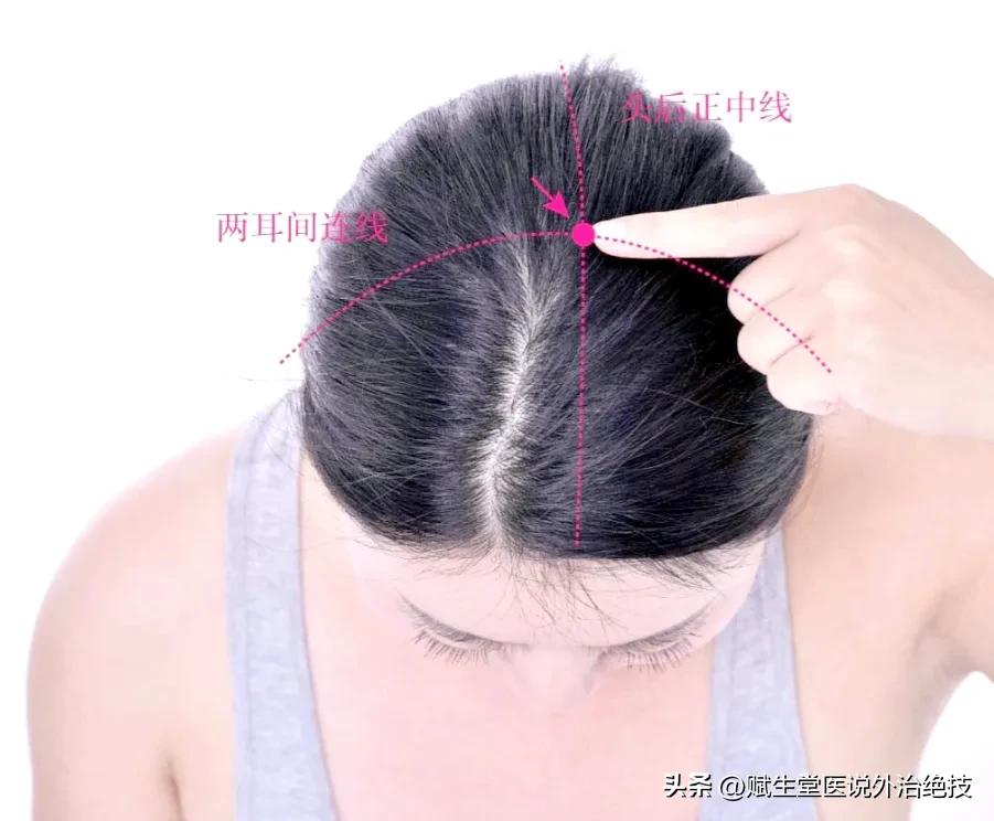 肝火上炎，五穴一方来解决