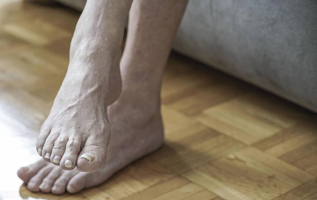 花大价钱买网红贴身衣物竟然染上脚气？幸好中医有妙方，从根下药