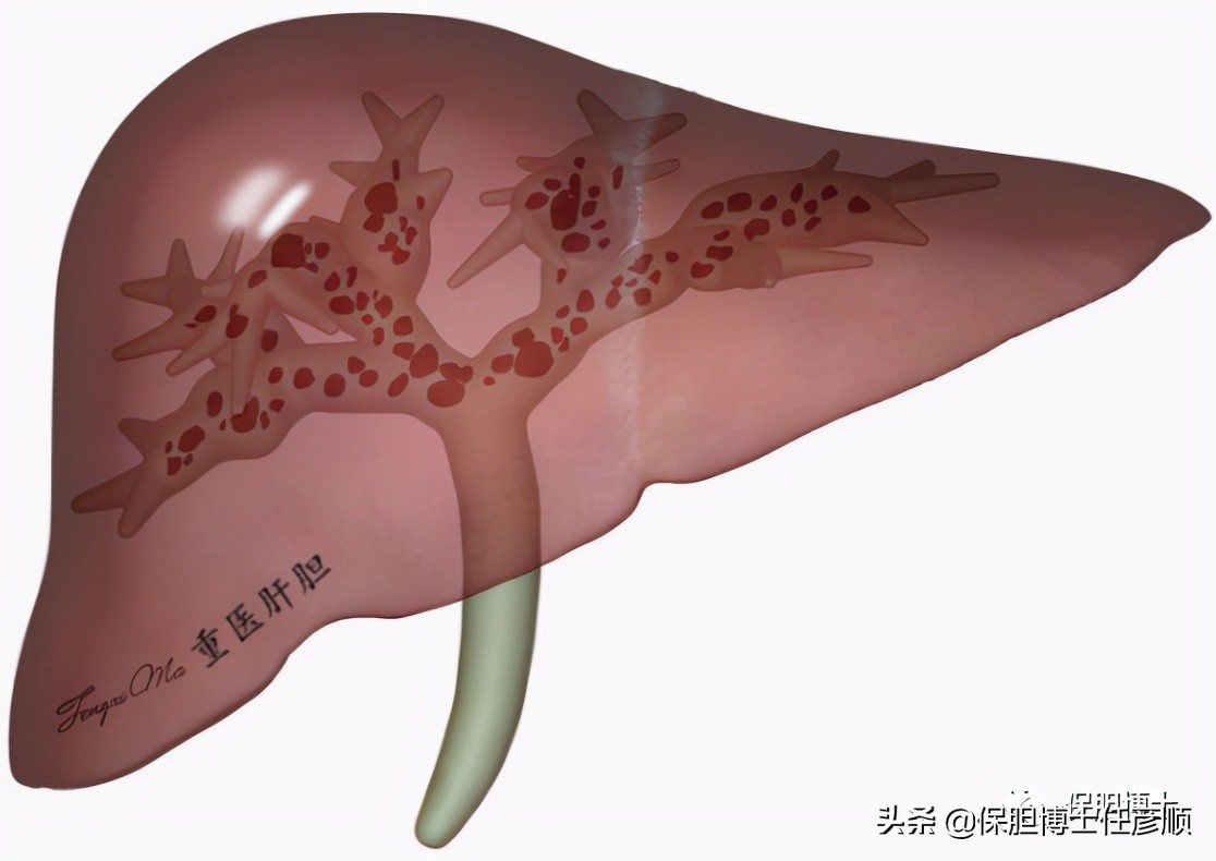 肝内胆管结石能保胆取石吗,肝脏结石能排吗