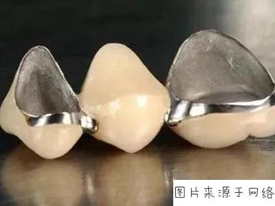 一分钟带你了解各种假牙,假牙基础知识