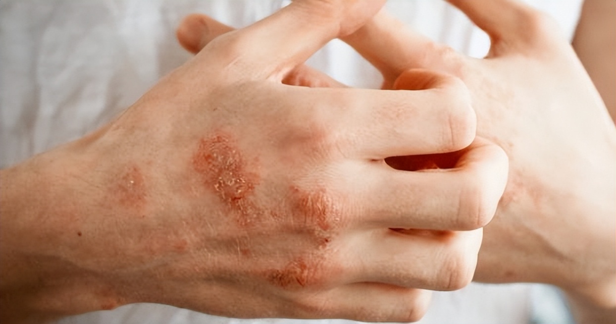 炉甘石洗剂现在要15元一瓶吗,炉甘石洗剂一瓶价格