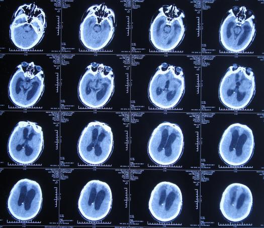 脑外伤后硬膜下积液颅骨修补,颅骨修复手术失败导致脑积水