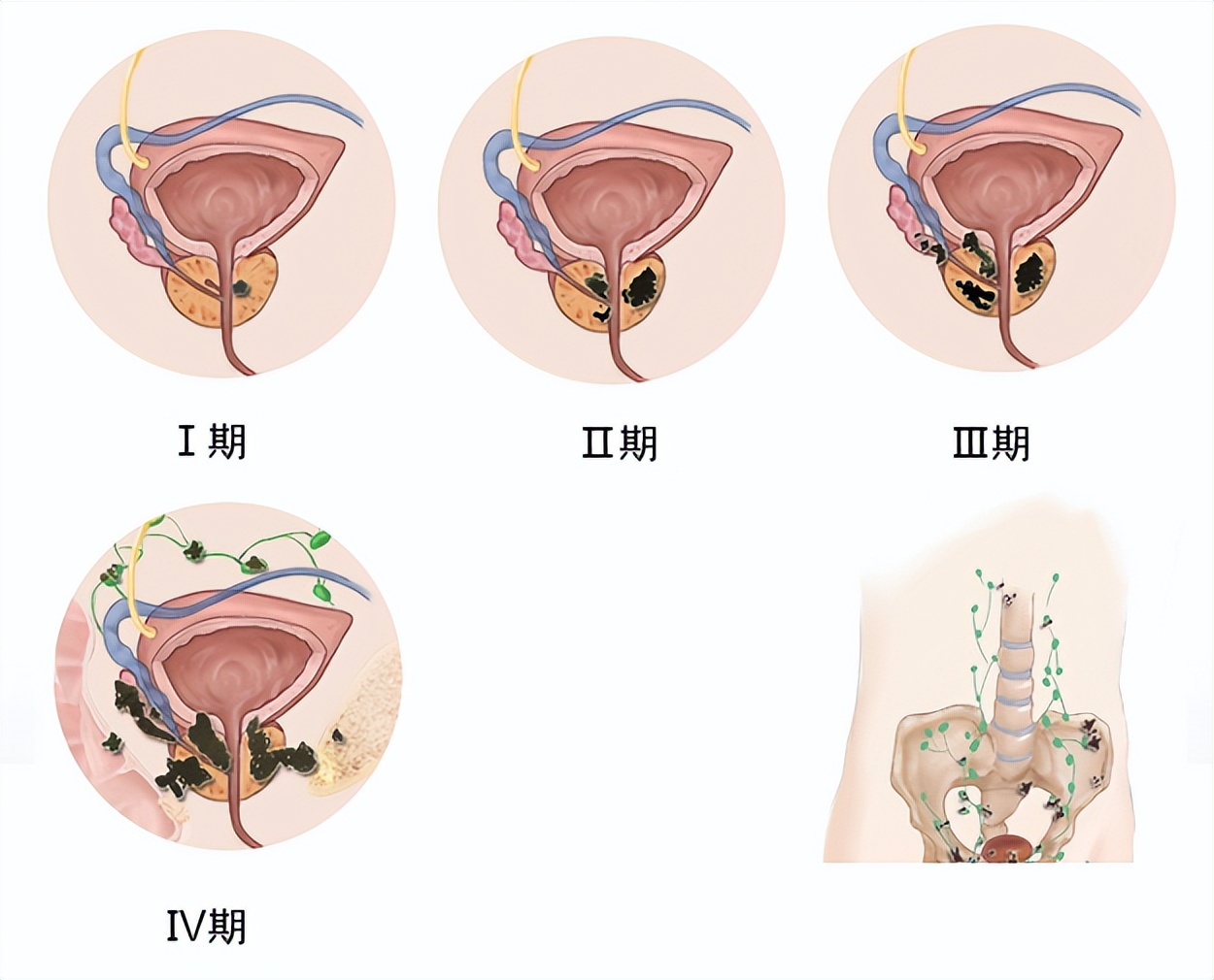 北医三院泌尿科专家治疗前列腺,关爱男性医学科普