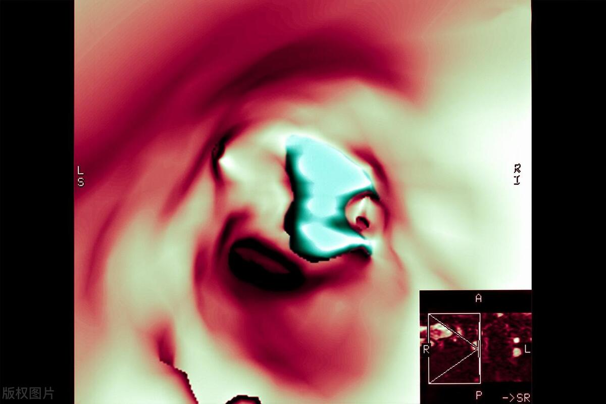 脑梗颈动脉斑块90%能治愈吗,有颈动脉斑块需要服他汀药吗