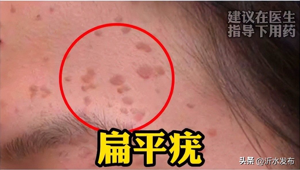 眼周长小小的疣,眼周长小丘疹是怎么回事