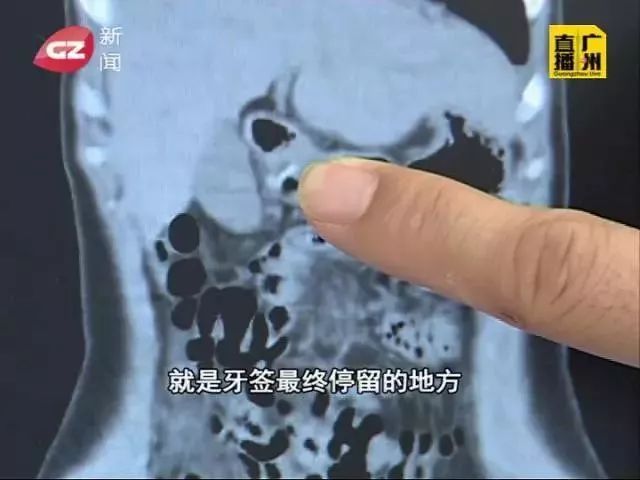 误吞牙签怎么办,少年误吞牙签一个小妙招