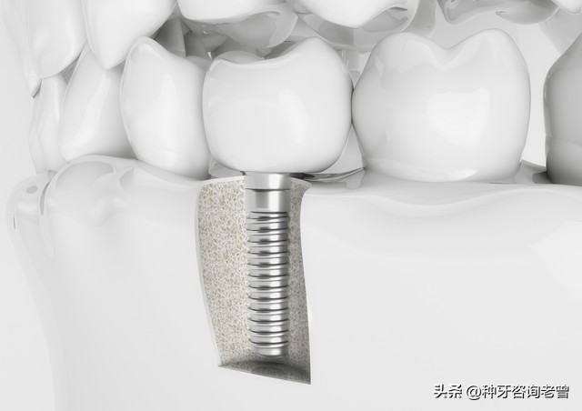 种植牙需要注意哪些坑,种植牙如何避免踩坑