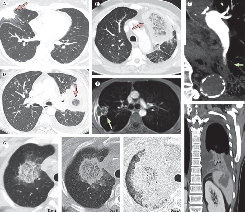 免疫缺陷病会并发什么病,什么是免疫缺陷肺部感染
