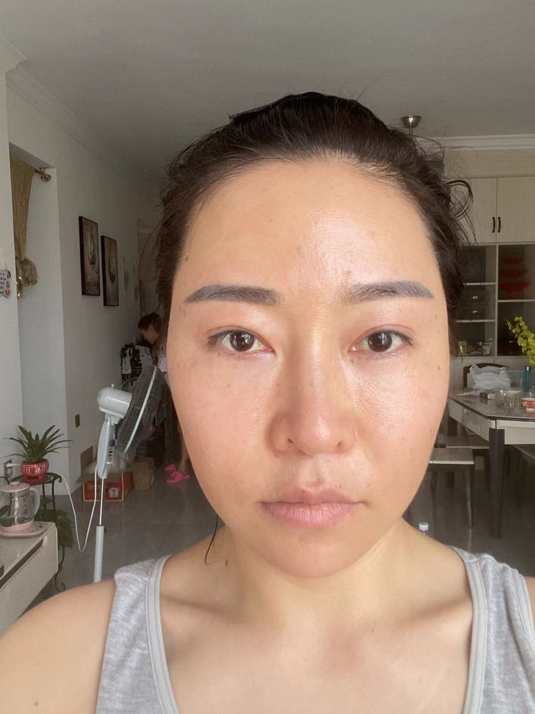 眼部提肌手术副作用,眼部提肌术可以不割双眼皮吗