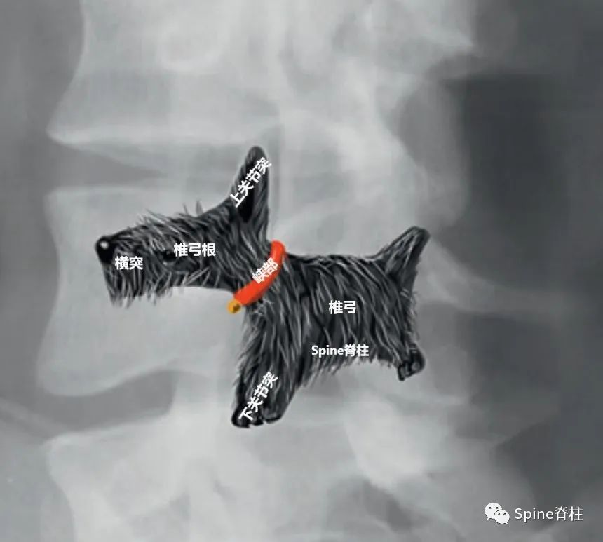 轻度峡部裂和重度峡部裂的区别,真性峡部裂和假性峡部裂