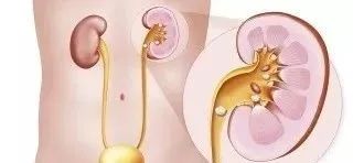 肾结石疼痛最有效的止痛方法,肾结石疼痛吃什么药暂时止