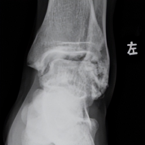 脚踝扭伤的处理方法和康复,脚踝扭伤立即进行的正确处理方法