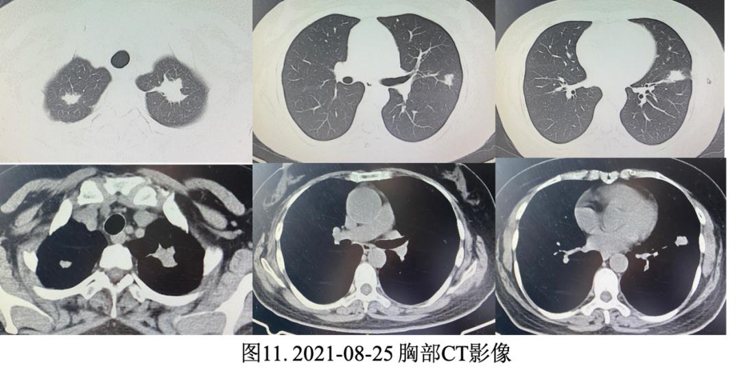 妇女双肺多发结节，病理示炎症，病情持续进展如何揭疑？