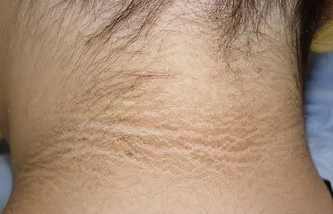 肥胖引起的黑棘皮图片,重度肥胖人黑棘皮病能彻底治好吗