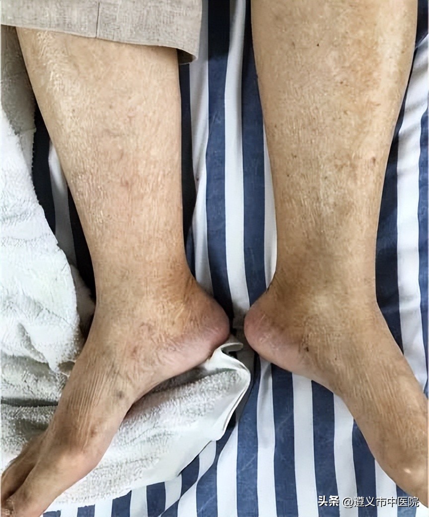 糖尿病肾病水肿不透析的后果,糖尿病肾病双腿水肿消除后疼痛