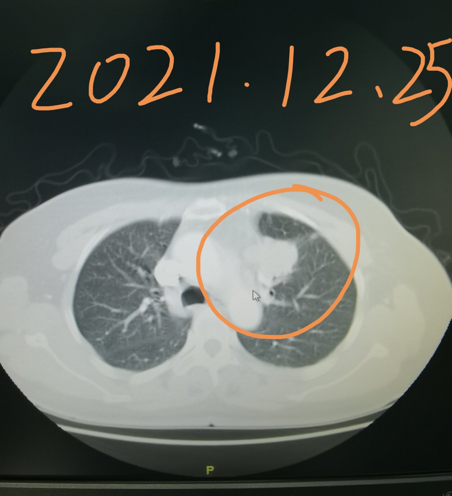 刘懿博士肺癌晚期症状,刘懿博士说肺癌微浸润复发