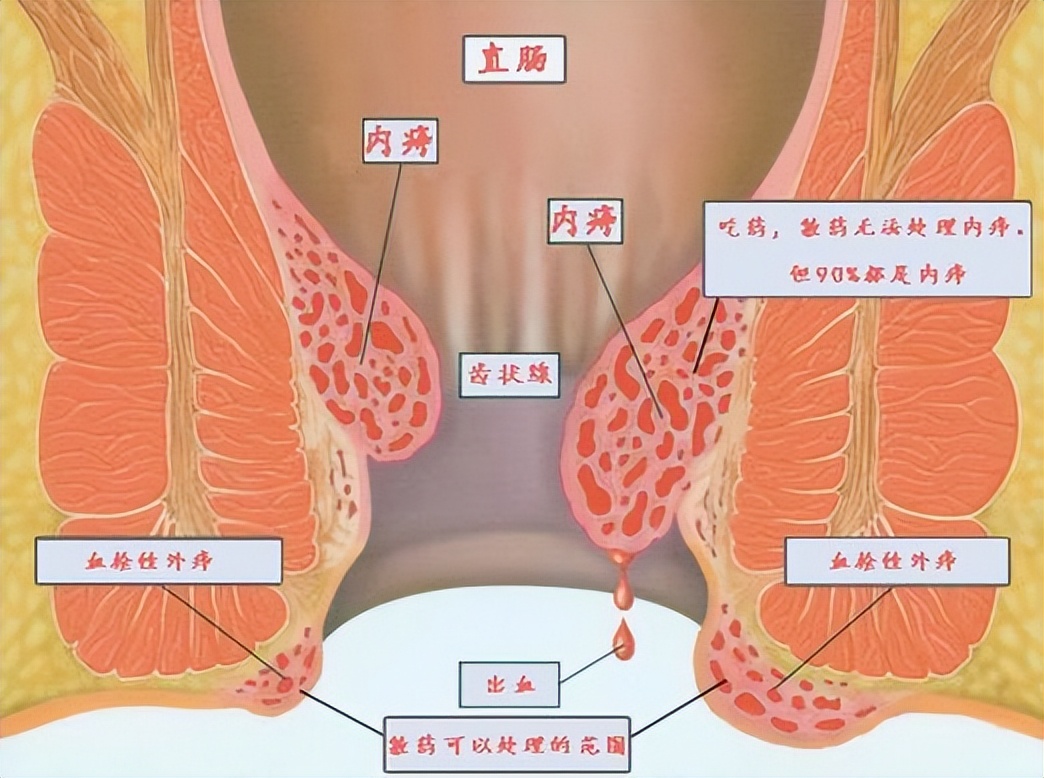 新龙甘消炎膏对痔术后疼痛及水肿的相关效性随机对照临床试验