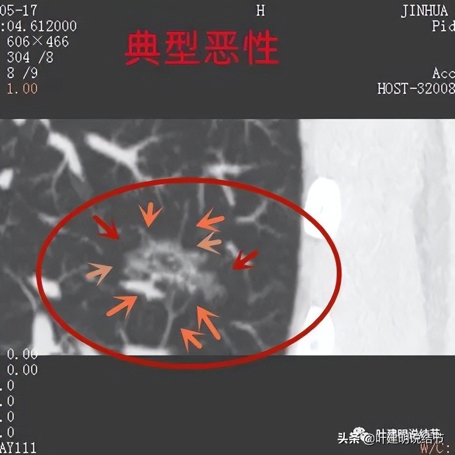 误诊肺纤维化,肺蜂窝状是癌吗