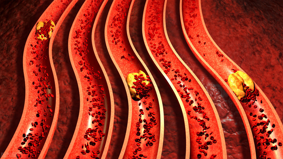 血管里有了斑块，怎么办？除了吃药，还有什么好方法