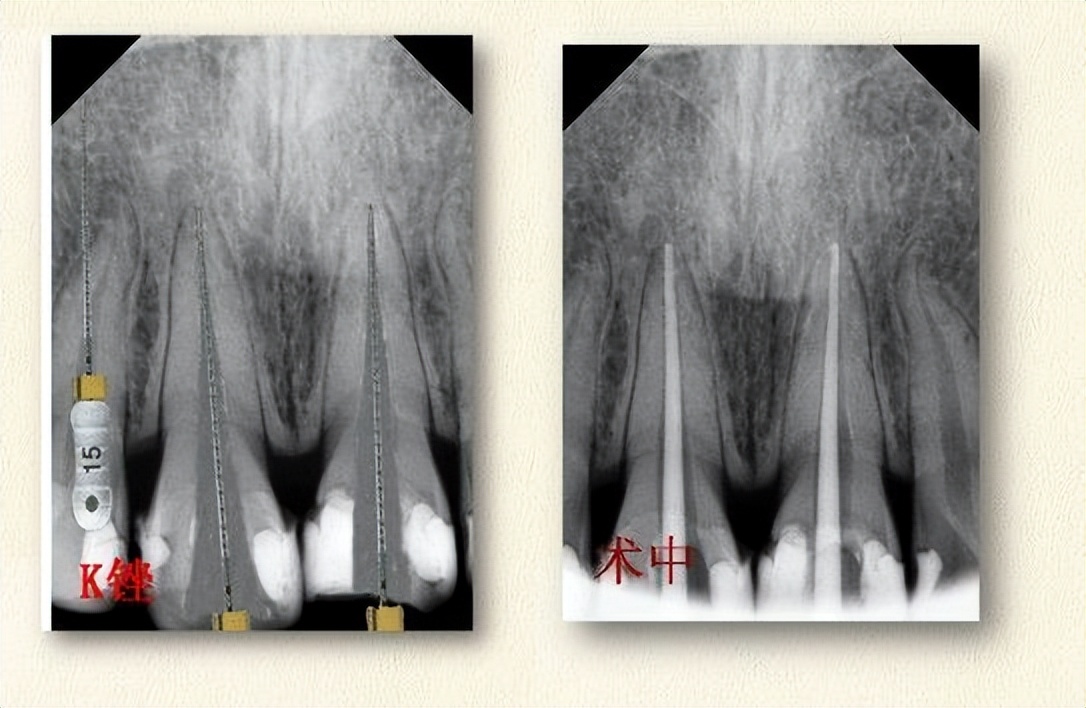 牙齿断了一半怎么处理最好多少钱,牙齿断了一半怕冰怎么处理最好